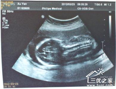 b超检查可以发现胎儿畸形