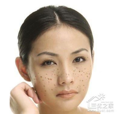 怀孕时吃什么才能让自己皮肤好,不长斑?