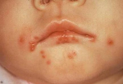 宝宝疱疹性口炎是怎么一回事?