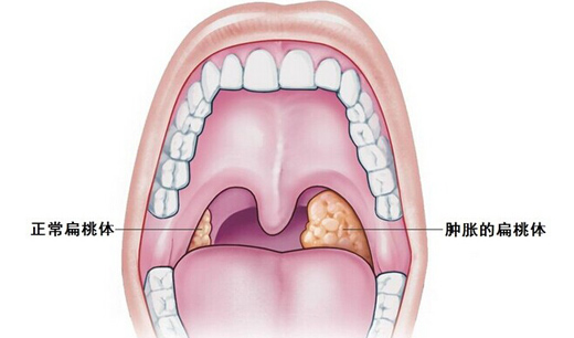 小儿扁桃体发炎发烧怎么办