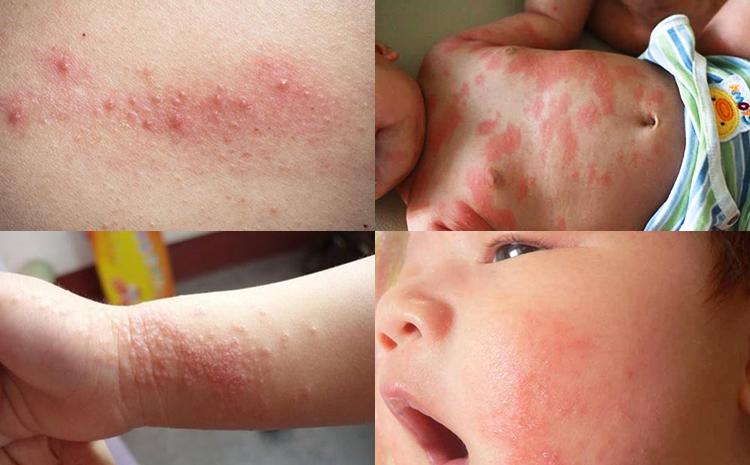 三优亲子联手儿科医生推出《小儿湿疹防护手册》，让孩子远离湿疹的困扰