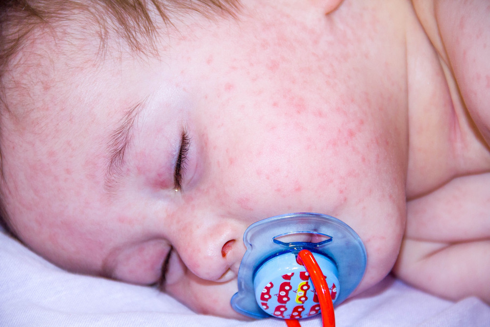 一个月婴儿有湿疹能打疫苗吗