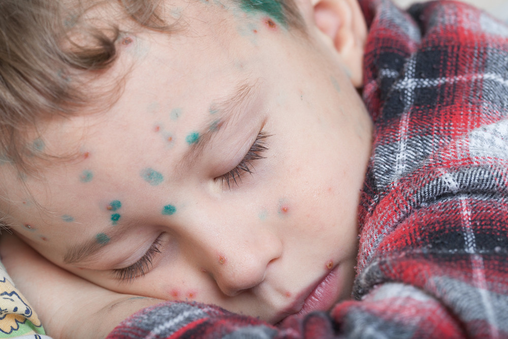两岁半宝宝有过敏性鼻炎怎么办